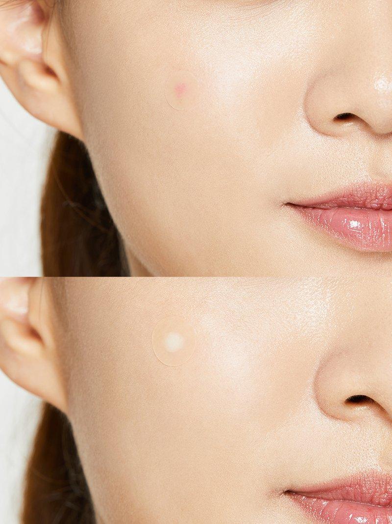 CORSX Acne Pimple Master Patch